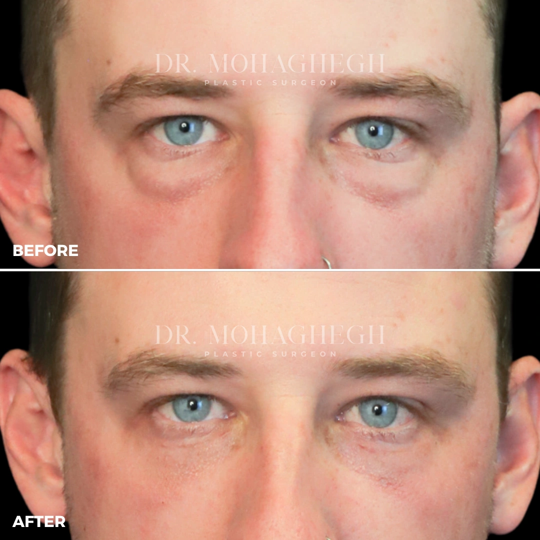 1_blepharoplasty