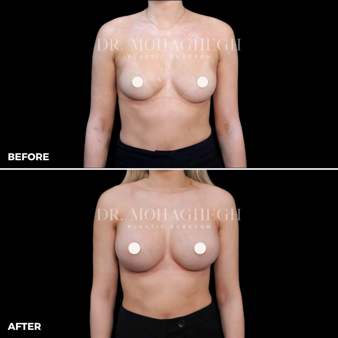 31_breast_augmentation