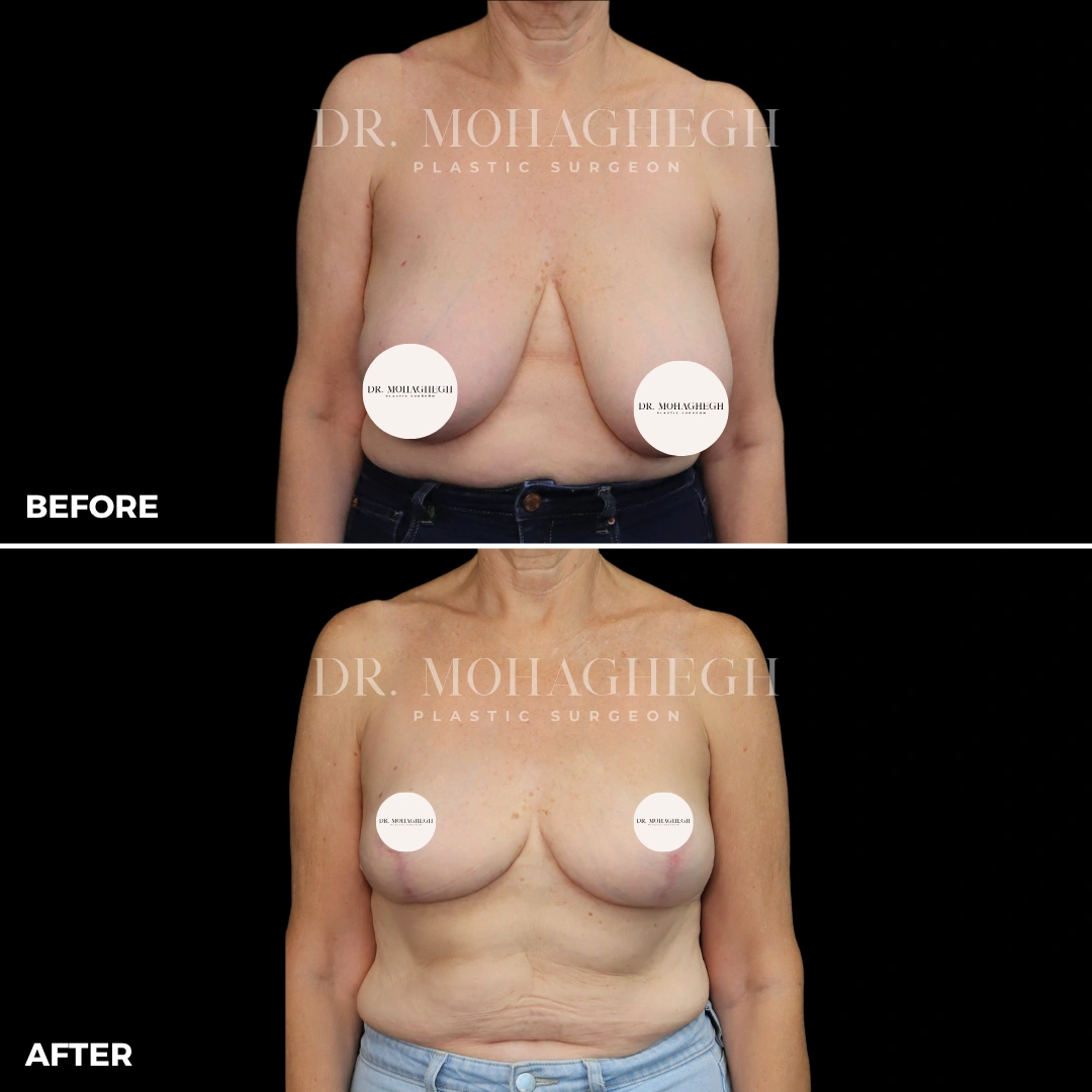 4_breast_reduction